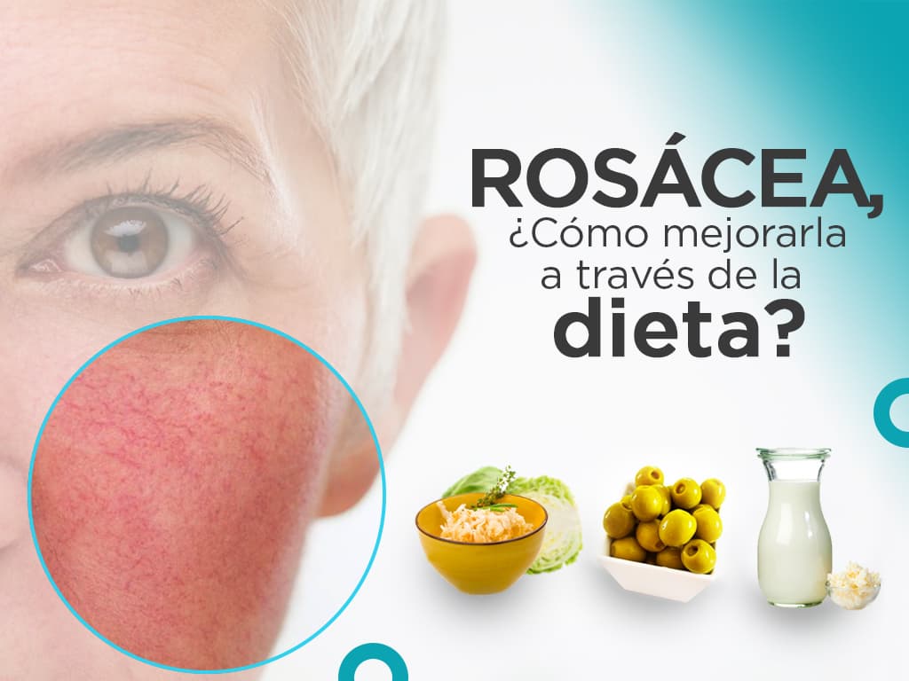 Read more about the article Rosácea, ¿cómo mejorarla a través de la dieta?