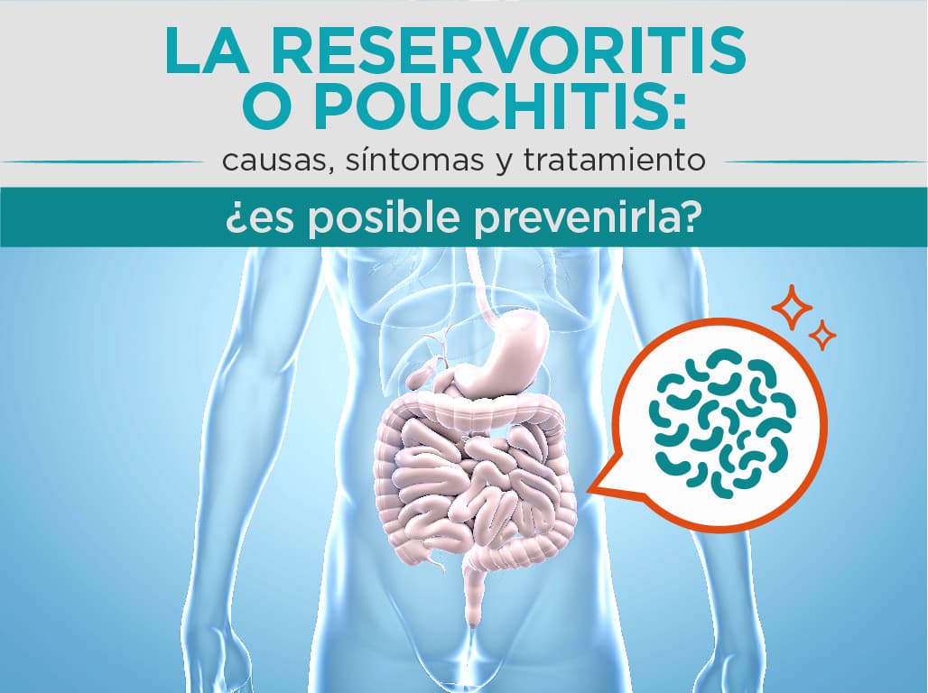 Read more about the article La reservoritis o pouchitis: Causas, síntomas y tratamiento. ¿Es posible prevenirla?