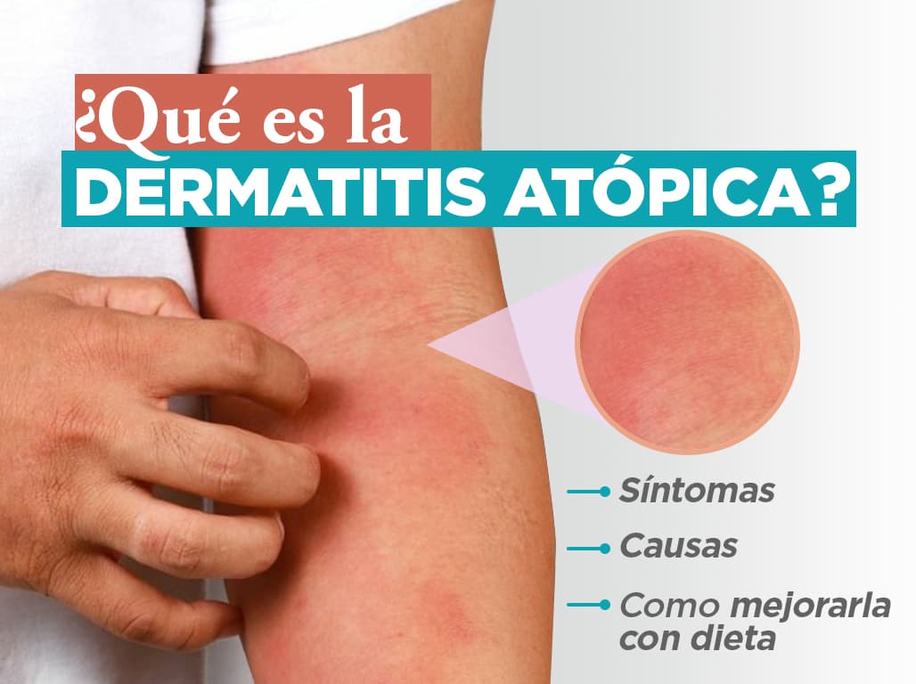 Lee más sobre el artículo ¿Qué es la dermatitis atópica? Síntomas, causa y cómo mejorarla con dieta